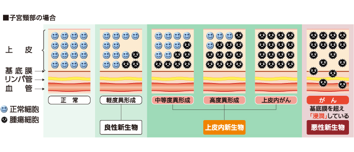 が ん ベスト ゴールド トップ 上皮 内 新 生物